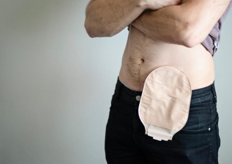 A person with t-shirt pulled up to reveal a colostomy bag