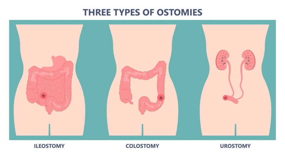 A graphic showing the three types of ostomies, Ileostomy, colostomy and urostomy