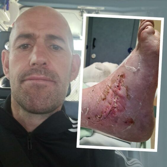 A selfie of Barry Douglas and, inset, his broken ankle after being operated on.