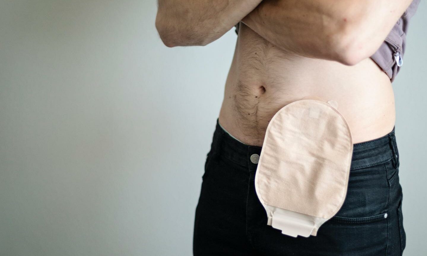 Some people with IBD may require surgery and a stoma bag.