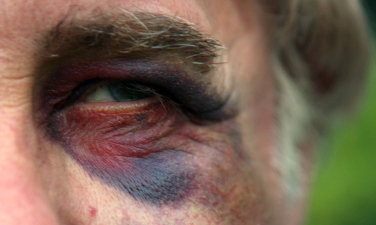 The assault left the 70-year-old with a badly damaged eye.