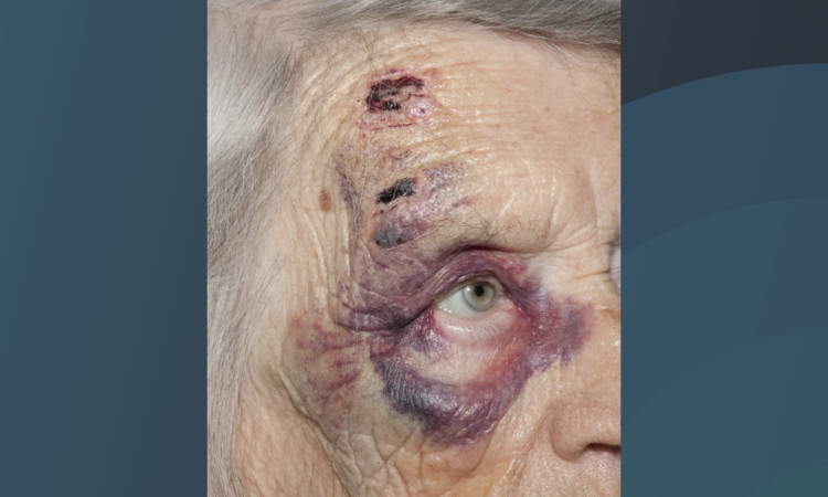 The pensioner was attacked after confronting thieves in her home in Wickford, Essex.