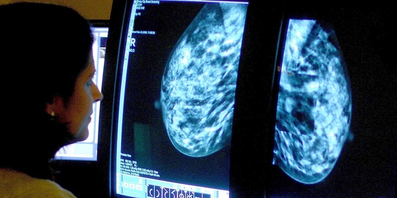 File photo dated 15/06/06 of a consultant analyzing a mammogram. One in five breast cancer patients sees the disease return, research suggests. Scientists found that 22.6% of women face disease recurrence.