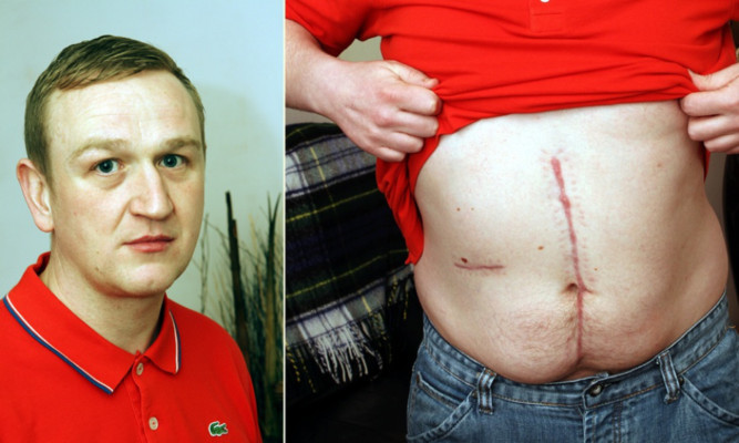 Marc Ritchie shows the scars he has been left with after emergency surgery to treat his knife wound.