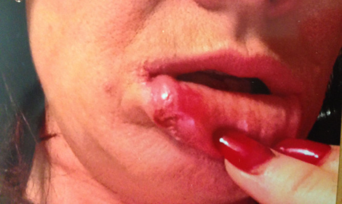 Julie Young was left with a bloodied lip.