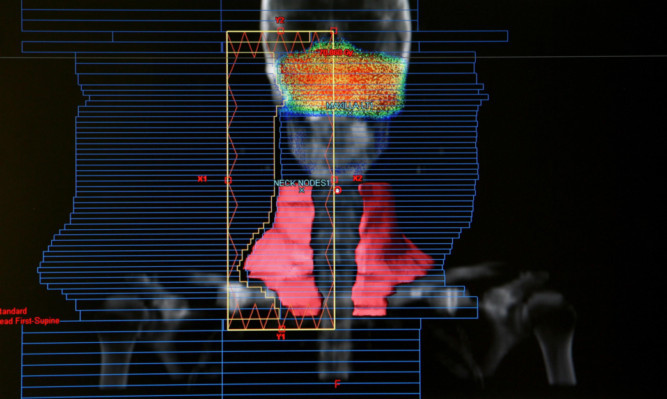 A computerised image showing a tumour and its subsequent treatment by radiotherapy.