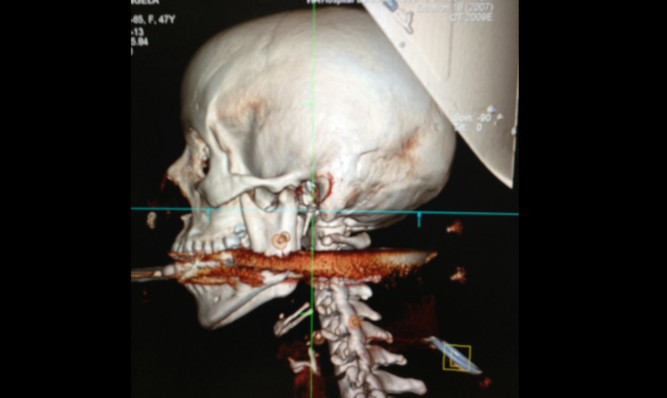 A hospital scan shows the spear piercing the woman's spine.