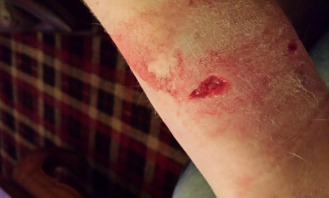 Wounds suffered by Alex Mackenzie after a dog attack in Arbroath