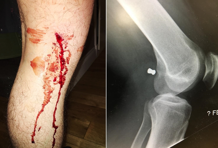 Jordan Fyfe was shot in the leg by an air gun while walking his dog in Kirkintilloch.