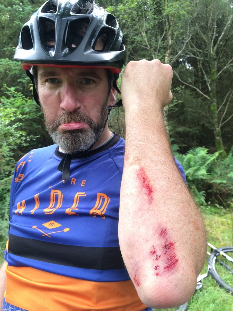 Scot and his injury after a stupid crash at Dalbeattie