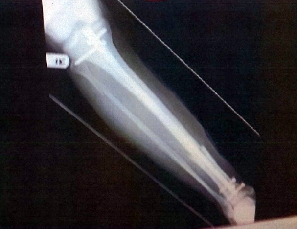 Mr Pain's shattered leg had to be rebuilt after the brutal assault.