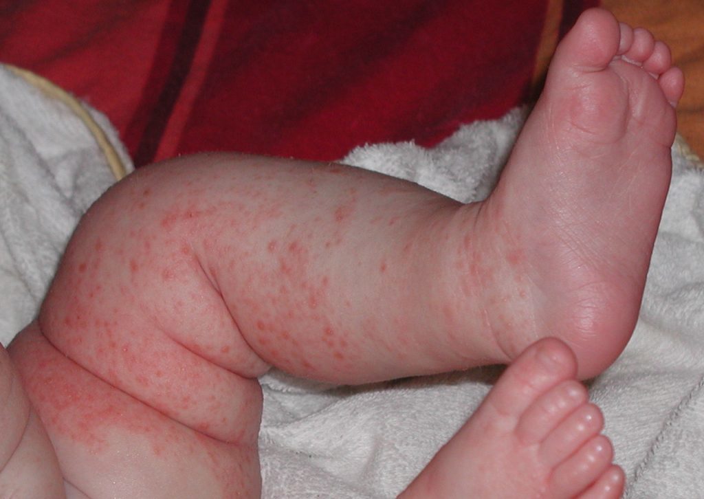 Eczema now affects 25 per cent of children in Scotland
