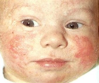 Eczema in children is on the increase