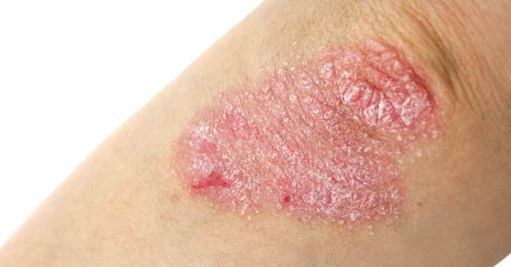 Eczema can range in severity