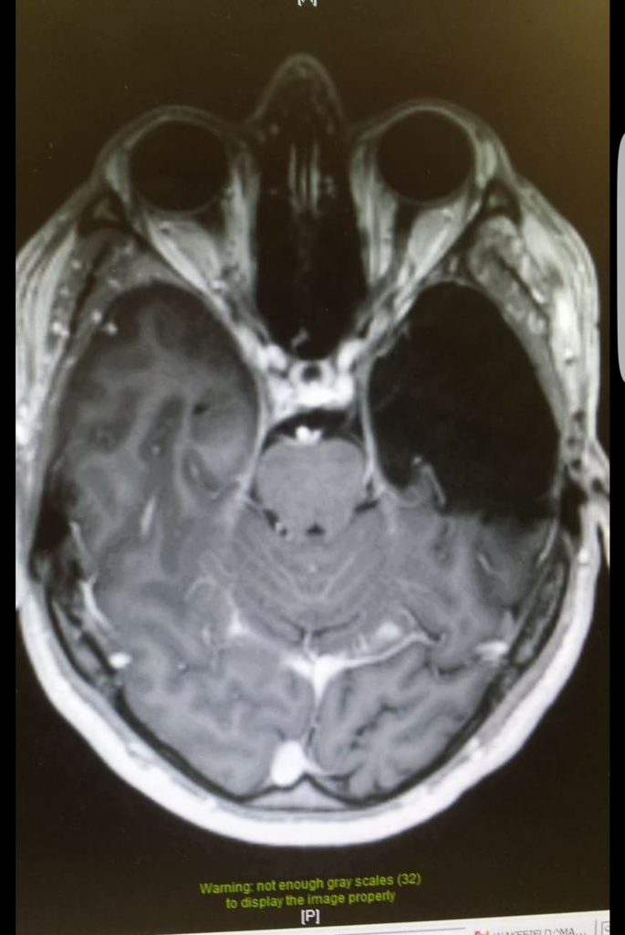 A dramatic x-ray image showing the extent of cancerous brain removed