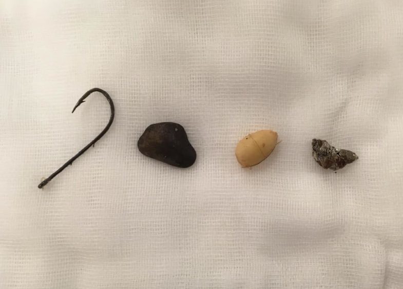 Some of the items removed during the surgery.