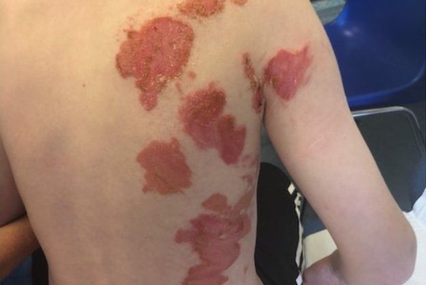 Ryan Griffin's back was badly burned in the incident and he may be scarred for life.