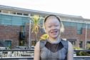 Tumeliwa Mphepo has spoken out about the persecution of people with albinism in Malawi.