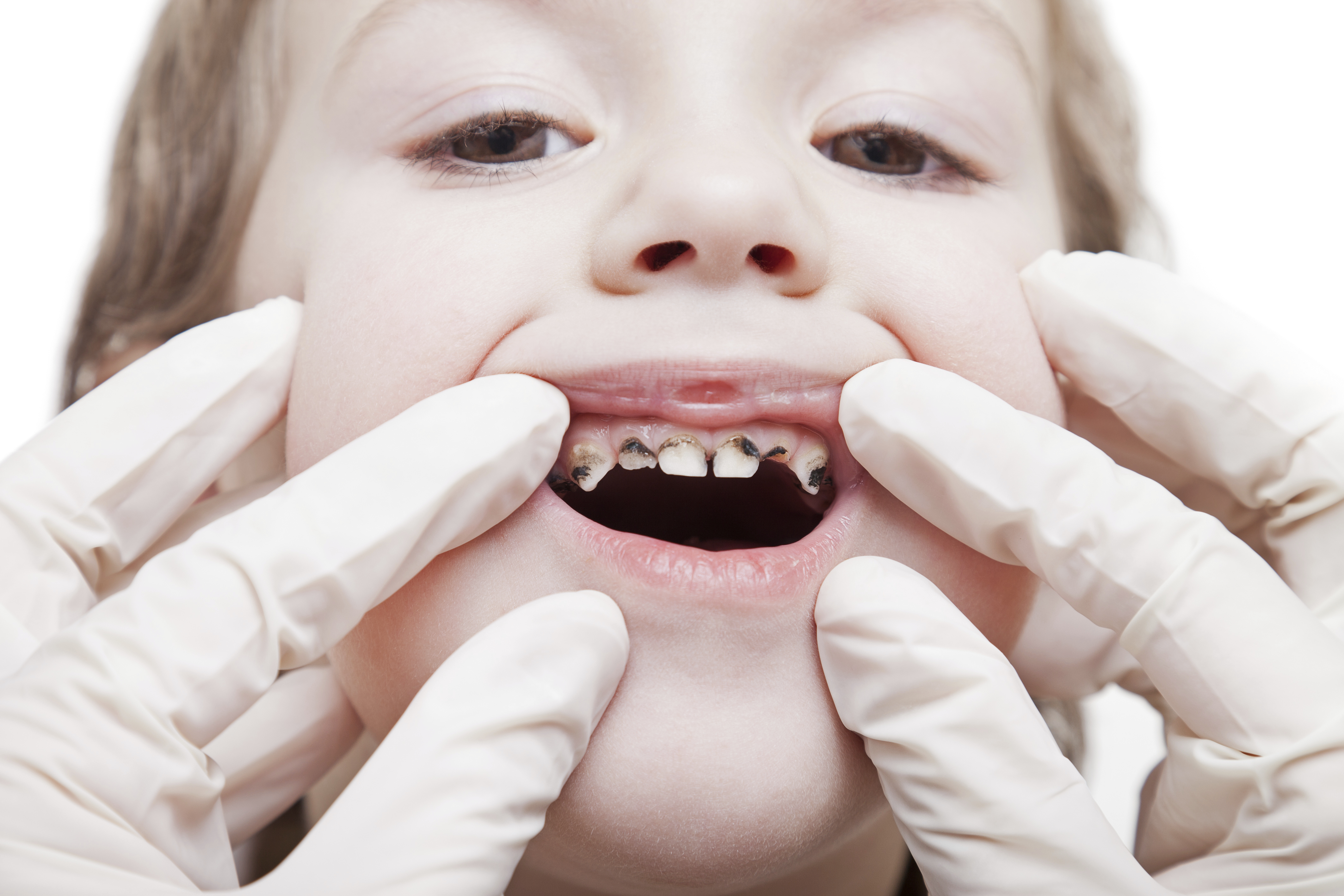 Dundee remains one of the worst places in Scotland in terms of childhood teeth decay