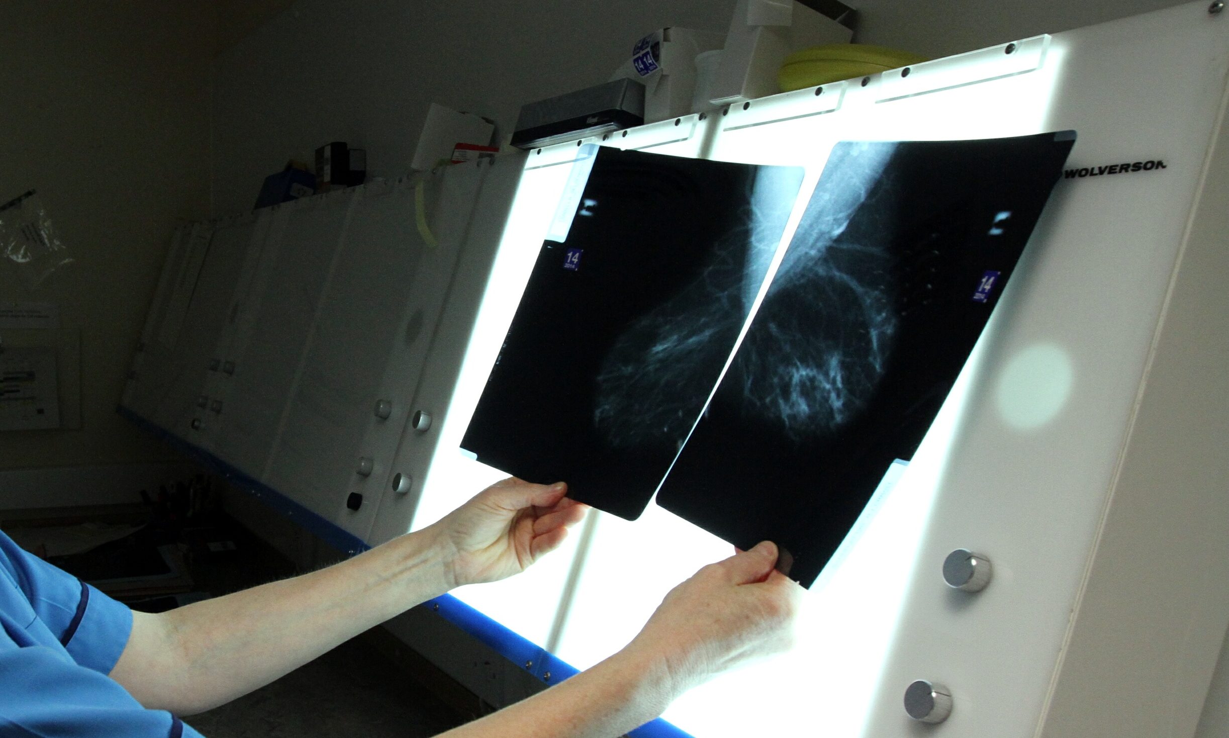 Breast x-rays are checked for abnormalities.