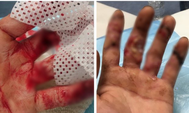 The graphic injuries have been blurred out in these photographs of Connor Penman's wounds.