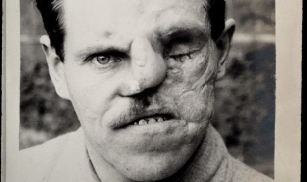 Wounded First World War soldier after surgery in 1918