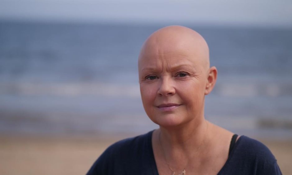 Photo shows Gail Porter, who has lost her hair to alopecia.