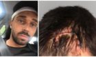 The 29-year-old was taken to Ninewells Hospital where he received 15 stitches to close a huge gash on his hairline.