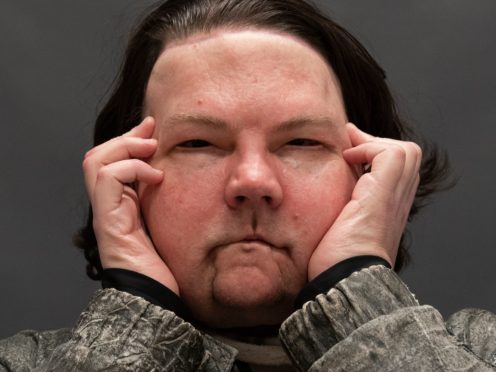 Joe DiMeo poses for a portrait, Monday, Jan. 25, 2021 at NYU Langone Health in New York, six months after an extremely rare double hand and face transplant. (AP Photo/Mark Lennihan)