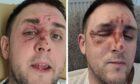 Perth man Gary McDougall was left with painful burns after a kitchen mishap