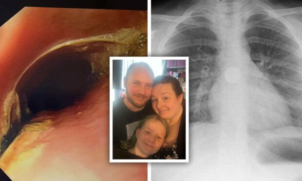 Sarah Wallace with her mum and stepdad. Right, an x-ray of the battery in her throat and left, the damage caused by the battery.