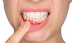 teeth - things to consider before dental implant treatment