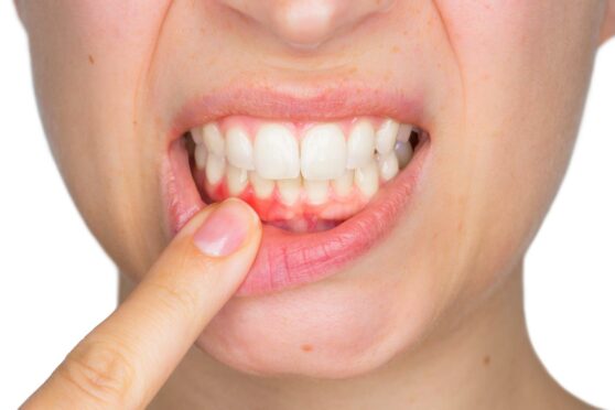 teeth - things to consider before dental implant treatment