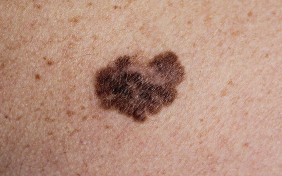 An example of melanoma.