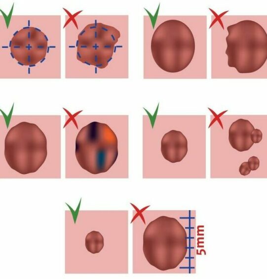 Green indicates healthy moles: symmetrical, flat, contained and with even edges, while those with the red crosses indicate signs of melanoma.