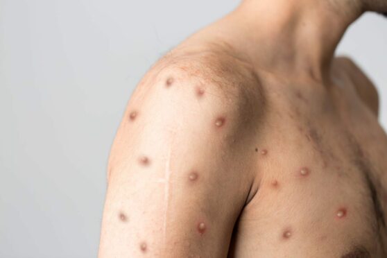 Monkeypox symptoms and spots differ from chickenpox.