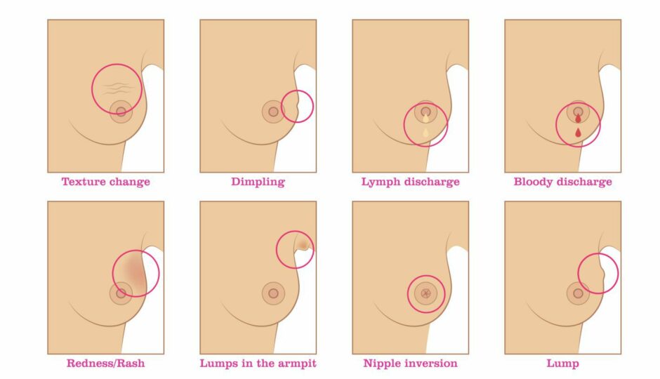 Some of the breast changes that can indicate breast cancer.