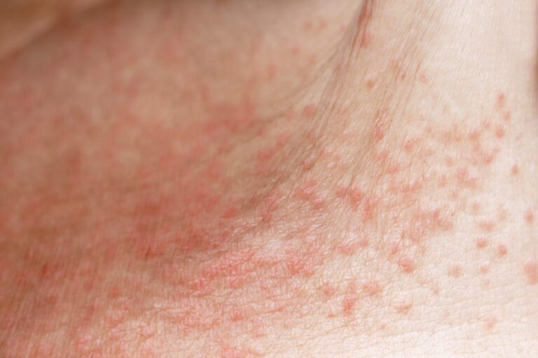 What is a heat rash and how can you get rid of it quickly?