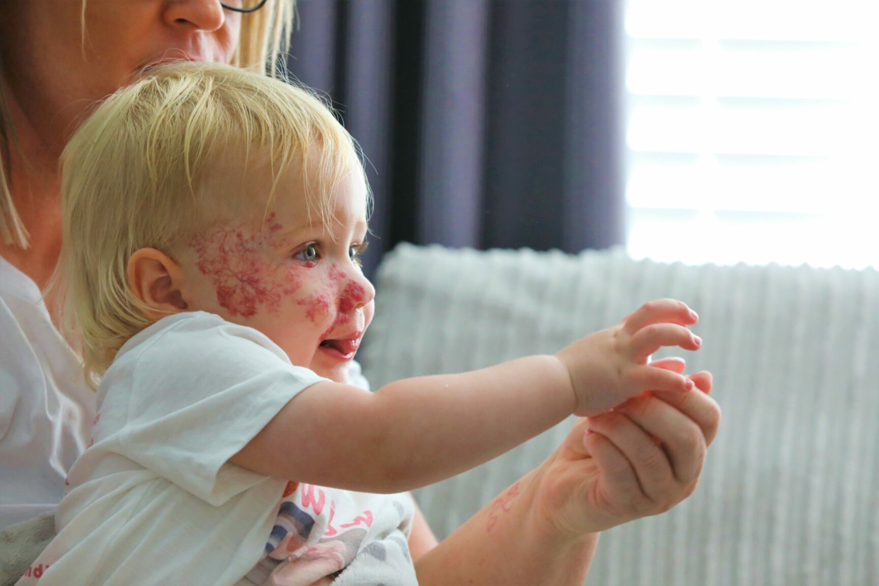 How baby Willow born with face birthmark helps families in Tayside