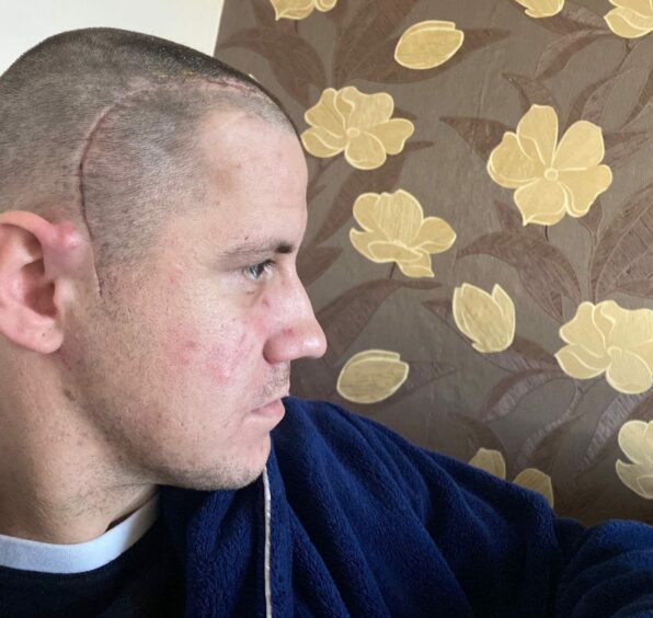Dad Bartosz Maroszek shows off scars from brain tumour surgery.