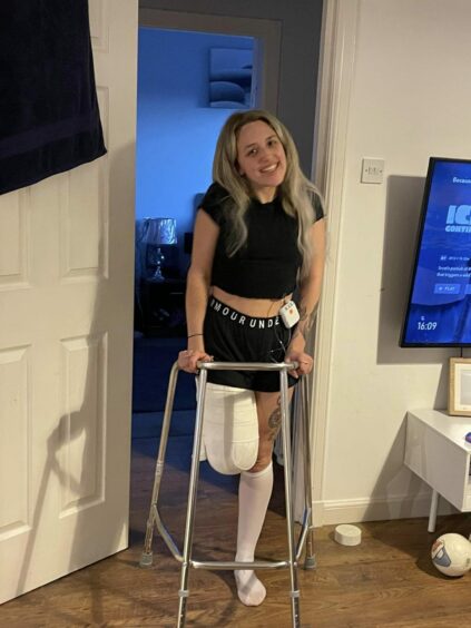 Dundee woman Chantelle after having her leg amputated