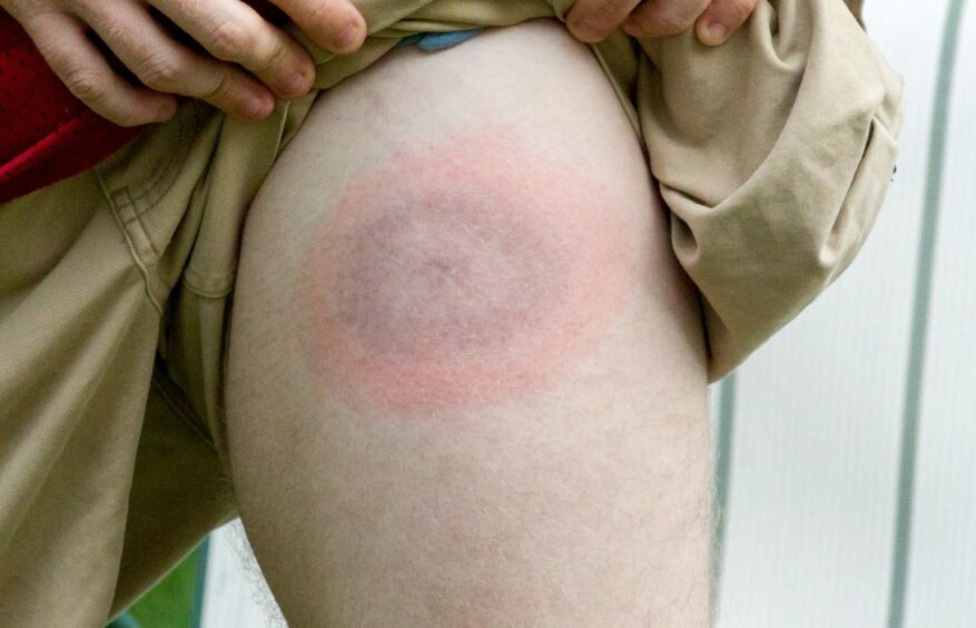 This is an example of a large bulls eye on young man's leg caused by Lyme disease. Image: Shutterstock.