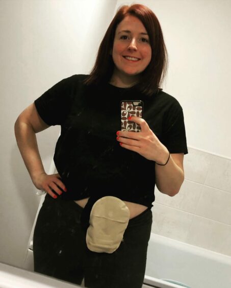 Katie said having the stoma bag proved to be life changing. Image: Katie Nicol.
