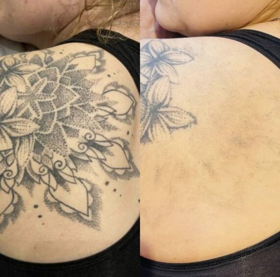 Tattoo removal process by Smooth Clinic.
