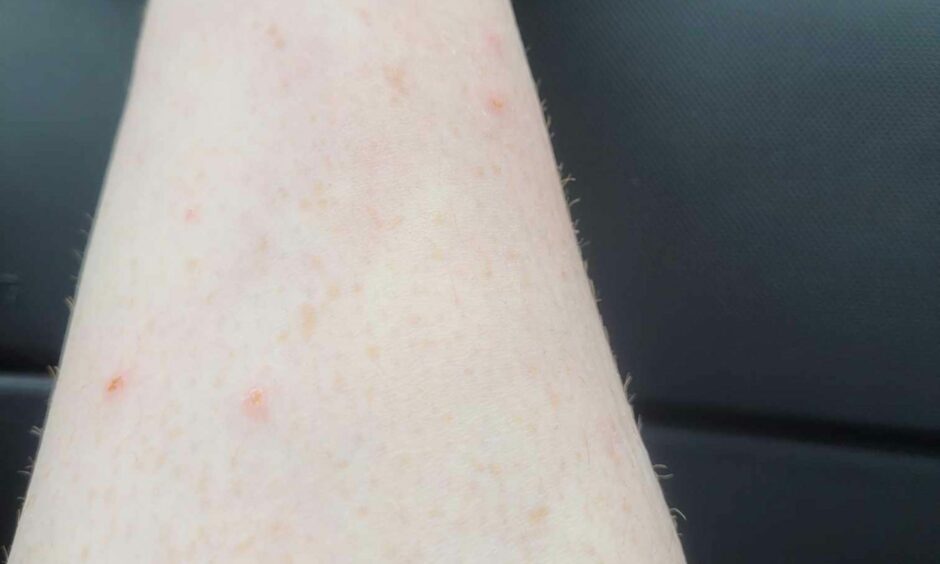 The infected flea bites on Jenn Humphreys.