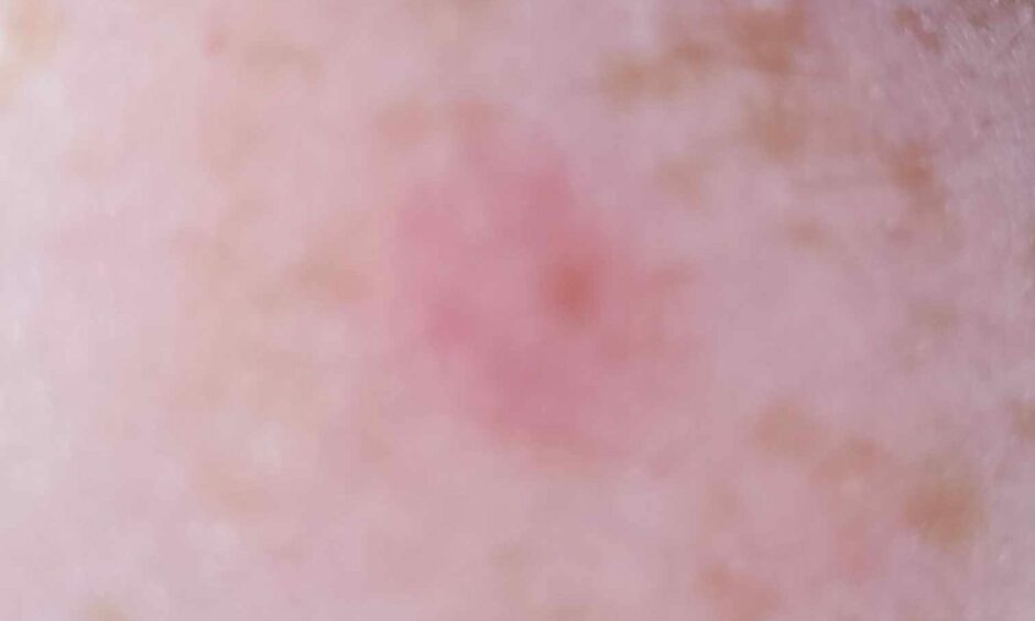 An infected flea bite on Jenn Humphreys.