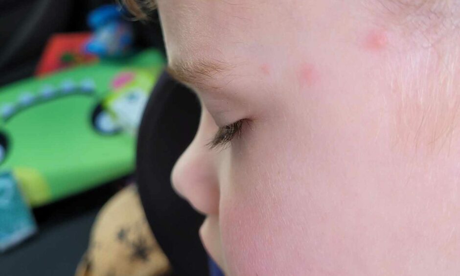 Flea bites on Jenn Humphreys' son's face.