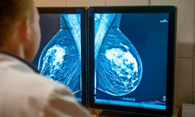 NHS Tayside breast cancer