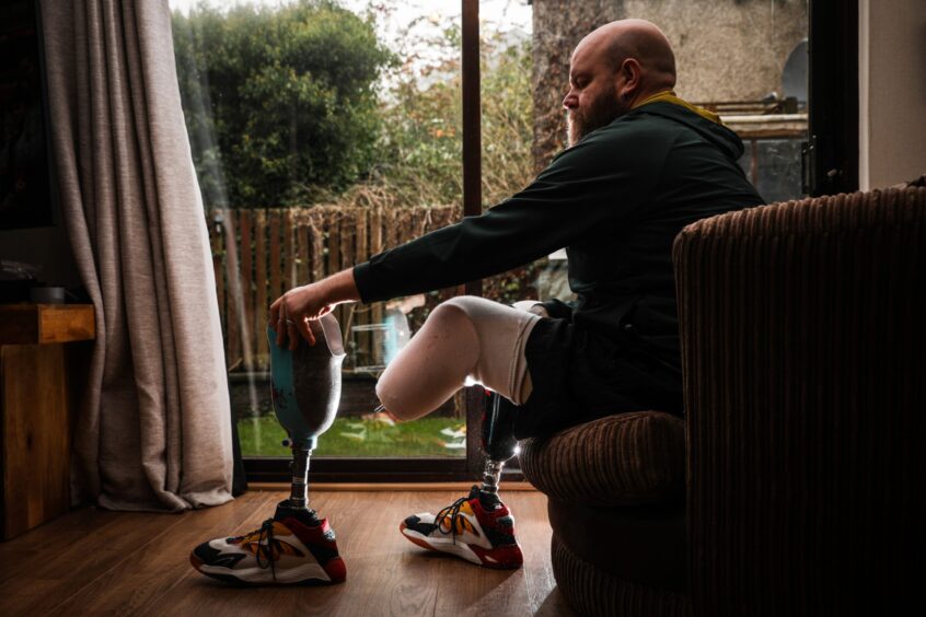 Double amputee Scott Campbell had to have both lower limbs removed due to infections arising from complications with his diabetes.