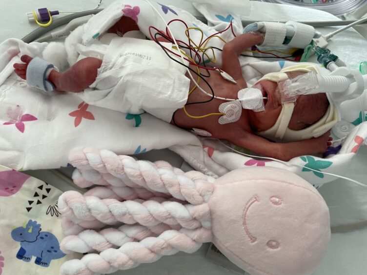 Baby Daisy was born very prematurely at just 29 weeks.